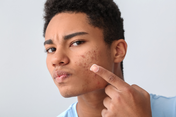 Da mụn có peel da được không?